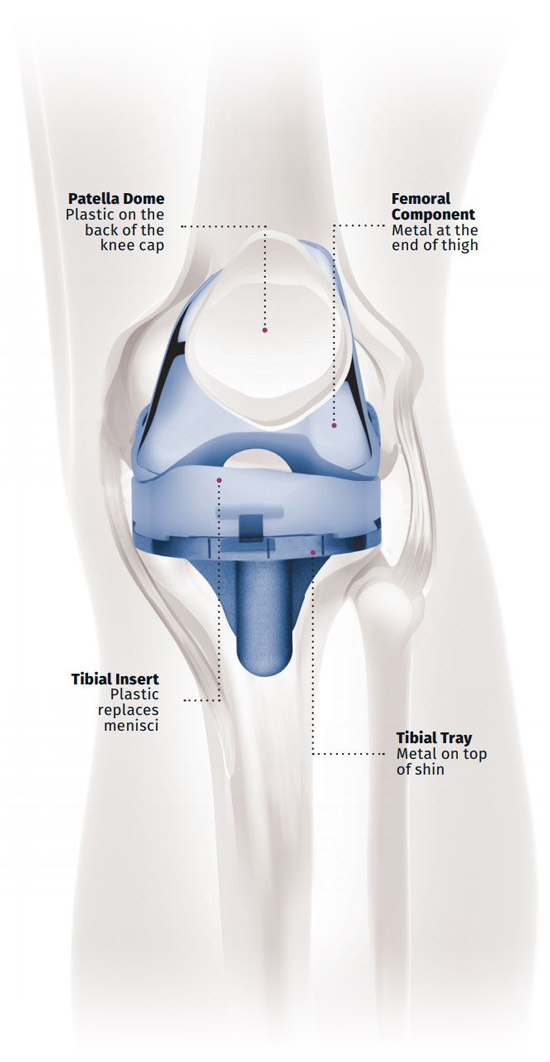 knee implant