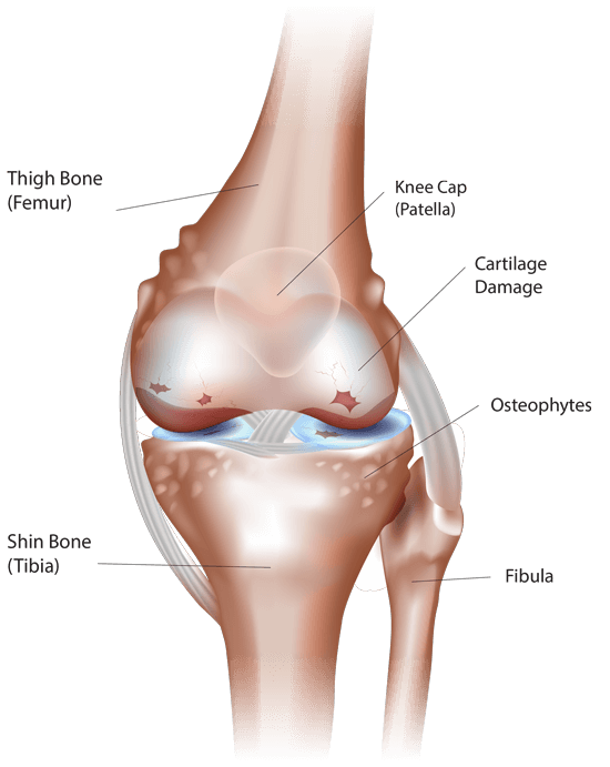 knee arthritis