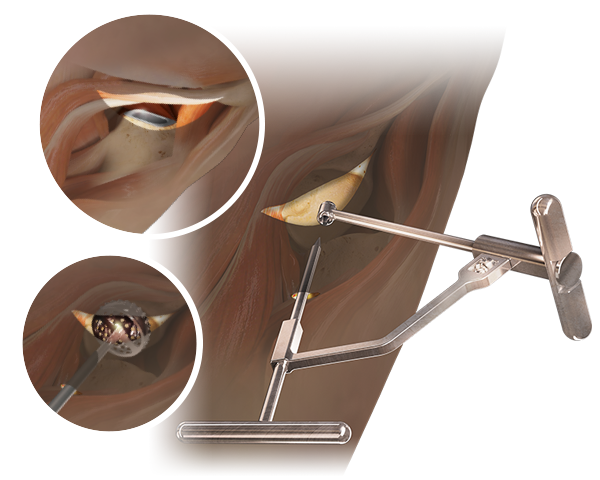 Anterior Path® Tissue Sparing Hip Approach