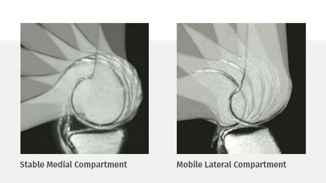 medial compartment